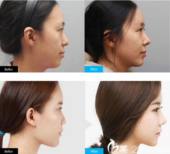 金虎吉院長假體隆鼻真人