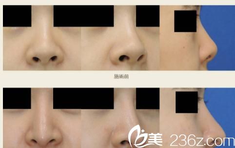 酒井直彥隆鼻術(shù)