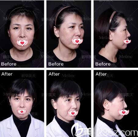 大連新華美天激光祛雀斑真人前后效果對(duì)比