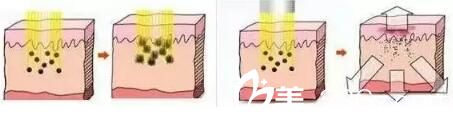 激光祛雀斑過(guò)程圖解