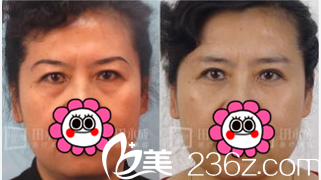 北京永成魅力醫(yī)院眼袋失敗修復(fù)多少錢？公布醫(yī)院價(jià)格表和田永成祛眼袋案例