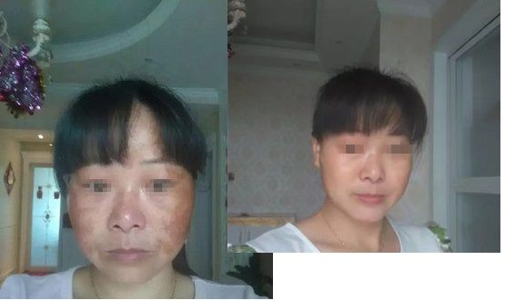 宜春祛斑哪家強？來圍觀這有兩位深受斑點困擾的求美者的祛斑經(jīng)歷