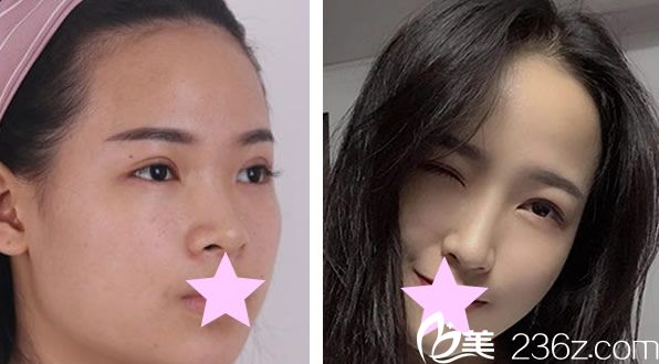 韓國TheOne整形方暖碩假體隆鼻+線雕隆鼻案例