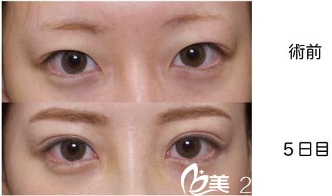 GL法埋設(shè)雙眼皮 GL法埋設(shè)雙眼皮