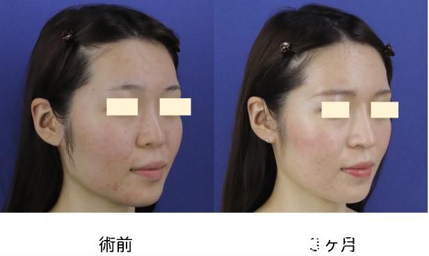 鼻中隔延長(zhǎng) 鼻中隔延長(zhǎng)