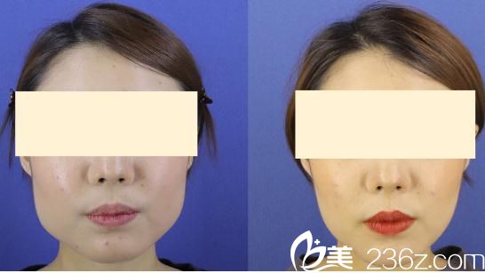 臉頰瘦臉除皺注射 臉頰瘦臉除皺注射