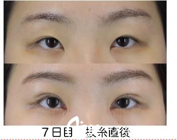 長(zhǎng)瀨大藏GL法埋設(shè)雙眼皮 長(zhǎng)瀨大藏GL法埋設(shè)雙眼皮