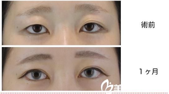 長(zhǎng)瀨大藏GL法埋設(shè)雙眼皮 長(zhǎng)瀨大藏GL法埋設(shè)雙眼皮