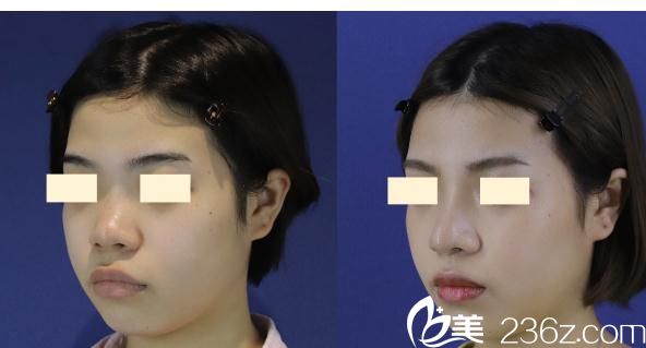 長(zhǎng)瀨大藏鼻中隔延長(zhǎng) 長(zhǎng)瀨大藏鼻中隔延長(zhǎng)