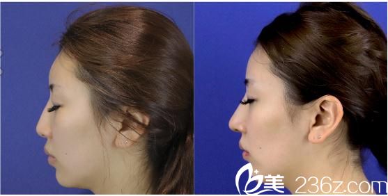 長(zhǎng)瀨大藏鼻中隔延長(zhǎng) 長(zhǎng)瀨大藏鼻中隔延長(zhǎng)