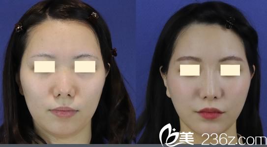 長(zhǎng)瀨大藏面部吸脂 長(zhǎng)瀨大藏面部吸脂