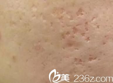 臉上有痘坑怎么辦？