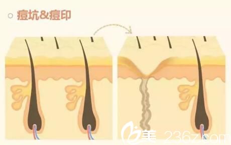 痘坑痘印的形成原因