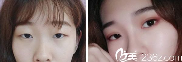 李成龍主任做眼綜合+全切雙眼皮案例 李成龍主任做眼綜合+全切雙眼皮案例