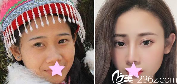 昆明夢想祝勇做自體脂肪面部提升效果案例圖 昆明夢想祝勇做自體脂肪面部提升效果案例圖