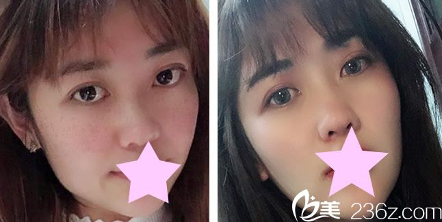 昆明夢想整形醫(yī)院胡凱激光祛斑術后效果圖 昆明夢想整形醫(yī)院胡凱激光祛斑術后效果圖