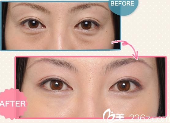 松倉(cāng)美容外科&醫(yī)療spa醫(yī)院玻尿酸注射