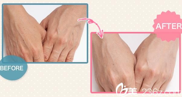 松倉(cāng)美容外科&醫(yī)療spa醫(yī)院玻尿酸注射