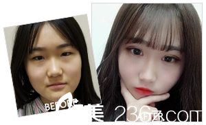 王來奎醫(yī)生眼鼻整形案例 王來奎醫(yī)生眼鼻整形案例