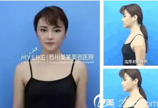 術(shù)前平胸自卑 術(shù)前平胸自卑