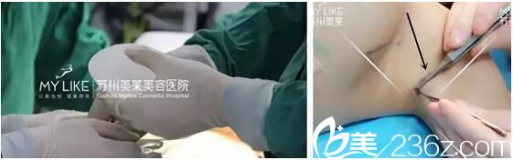 娜綺麗假體隆胸手術(shù)過程中 娜綺麗假體隆胸手術(shù)過程中