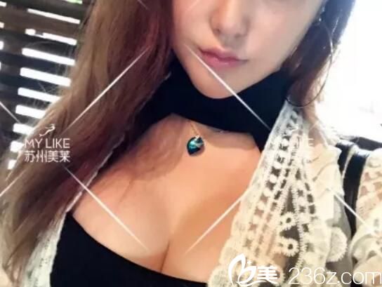娜綺麗290腋下隆胸案例分享：選對醫(yī)生90天妥妥恢復(fù)了