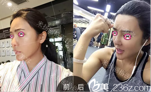 北京米揚麗格巫文云隆鼻修復(fù)案例