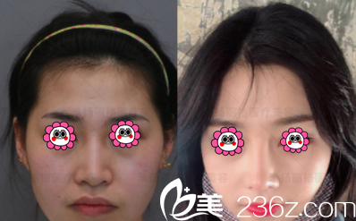 北京米揚麗格巫文云肋軟骨綜合隆鼻案例