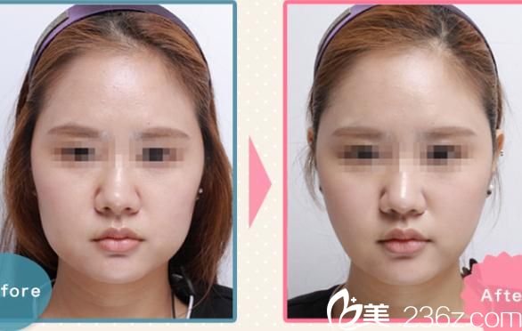 松倉(cāng)知之瘦臉除皺注射1