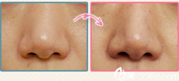 松倉(cāng)知之瘦臉除皺注射2