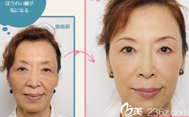 松倉(cāng)知之玻尿酸注射