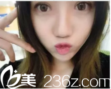 18.3.6榆林博愛(ài)整形美容醫(yī)院vs榆林美立方全切雙眼皮效果，恢復(fù)一年多和恢復(fù)半年多的妹子