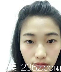 術(shù)前單的不能再單的雙眼皮