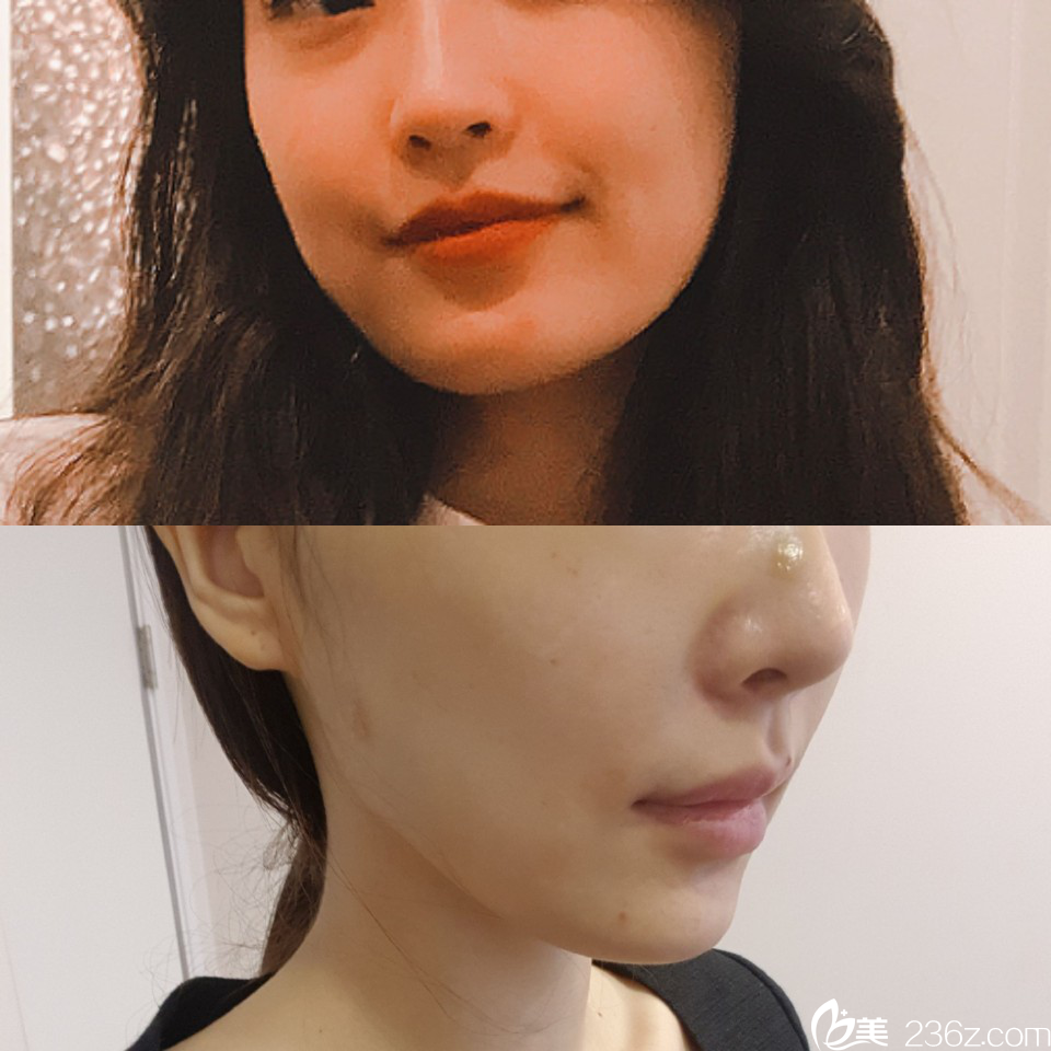 cavern線提升手術