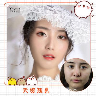 深圳yestar魏鑫銘做的鼻綜合隆鼻子案例 深圳yestar魏鑫銘做的鼻綜合隆鼻子案例