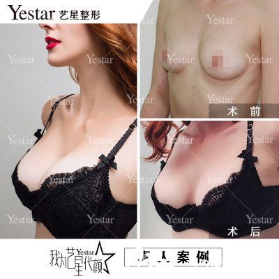 深圳藝星柯吟笑做的假體隆胸案例 深圳藝星柯吟笑做的假體隆胸案例