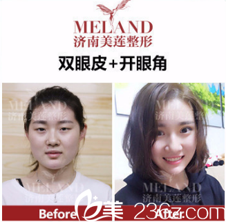 雙眼皮效果展示