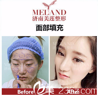 自體脂肪填充案例