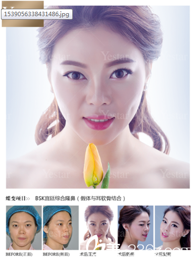 深圳yestar藝星整形魏鑫銘做的隆鼻子案例 深圳yestar藝星整形魏鑫銘做的隆鼻子案例