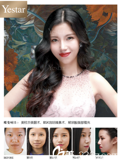 深圳yestar魏鑫銘做的美杜莎綜合美眼雙眼皮和隆鼻案例 深圳yestar魏鑫銘做的美杜莎綜合美眼雙眼皮和隆鼻案例