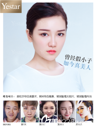 深圳藝星整形醫(yī)院魏鑫銘醫(yī)生雙眼皮隆鼻案例 深圳藝星整形醫(yī)院魏鑫銘醫(yī)生雙眼皮隆鼻案例