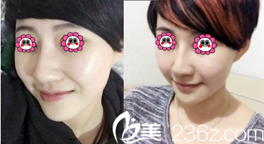 北京田永成醫(yī)院鼻綜合案例