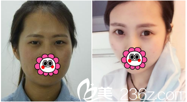 北京田永成醫(yī)院切開雙眼皮案例