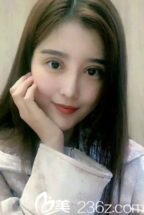 雙眼皮失敗修復(fù)術(shù)后五天圖