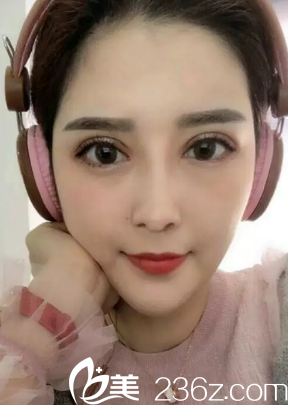 陳芝醫(yī)生雙眼皮修復(fù)術(shù)后40天