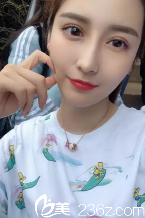 陳芝做的雙眼皮失敗修復(fù)80天圖