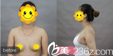 成都<!--<i data=20240709-sp></i>-->欒杰隆胸案例