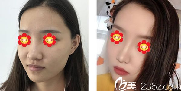 包頭汝森楊子偉醫(yī)生假體隆鼻+自體脂肪面部填充效果案例 包頭汝森楊子偉醫(yī)生假體隆鼻+自體脂肪面部填充效果案例