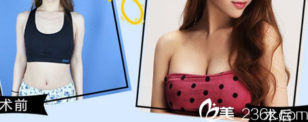 包頭汝森假體隆胸+自體脂肪豐胸真人案例 包頭汝森假體隆胸+自體脂肪豐胸真人案例