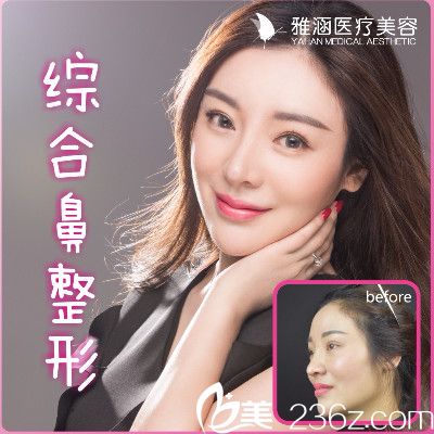 深圳雅涵高山做的鼻翼縮小案例